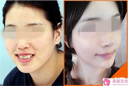 整容要花多少錢就整一張臉？深度解析全臉整形費用構(gòu)成與預(yù)算攻略